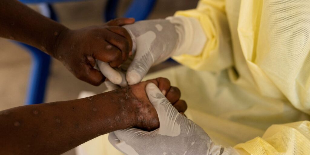 brasil-registra-88-casos-de-mpox-em-2026;-saiba-como-evitar-a-doenca